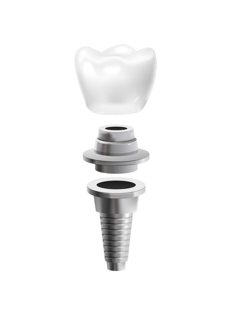 clinica-dental-jerez-implantes
