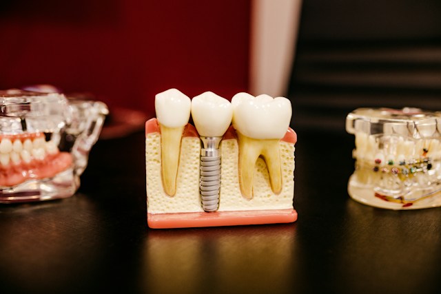 implantes dentales jerez